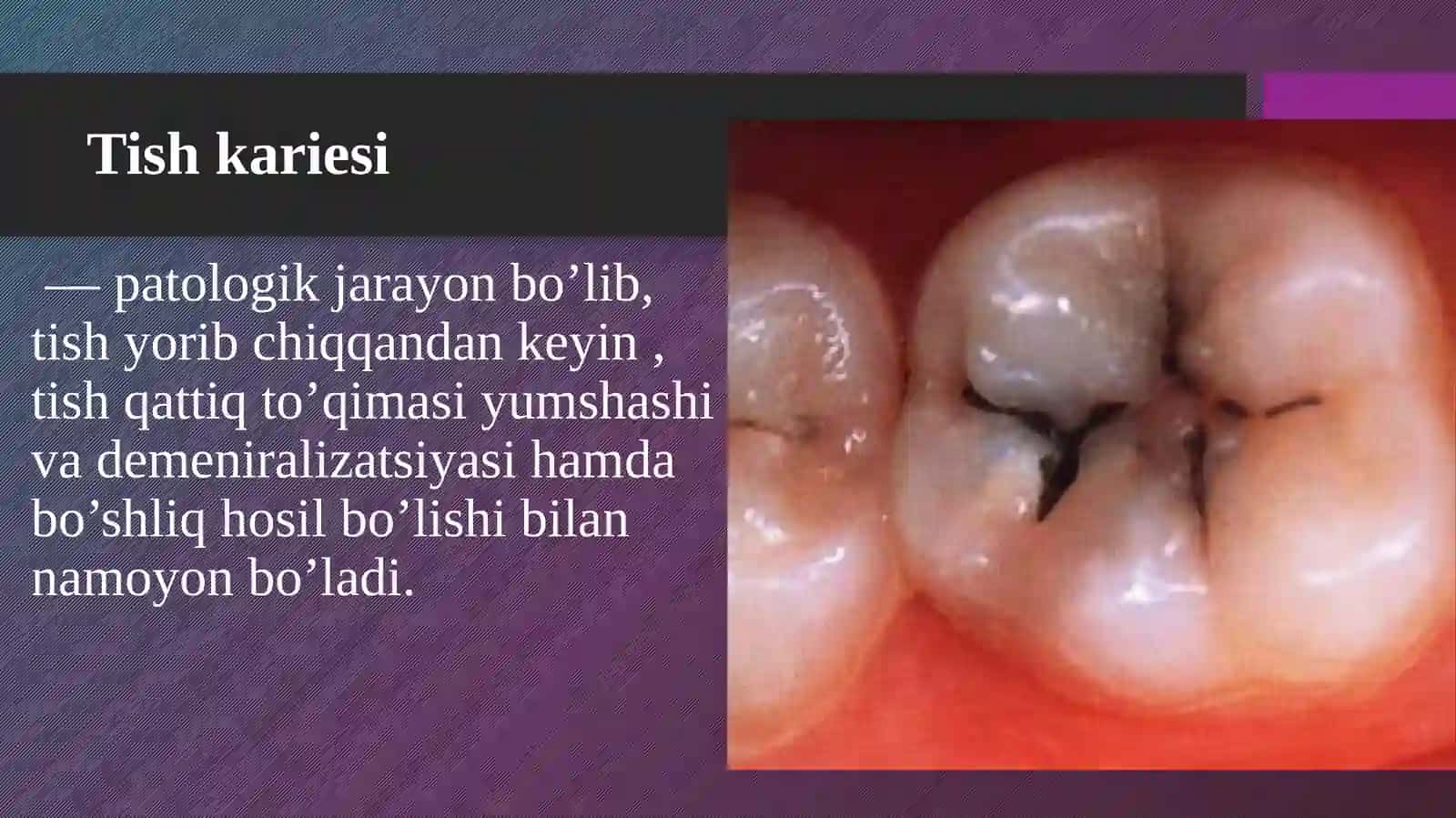 Karies haqida pirizintatsiya 2