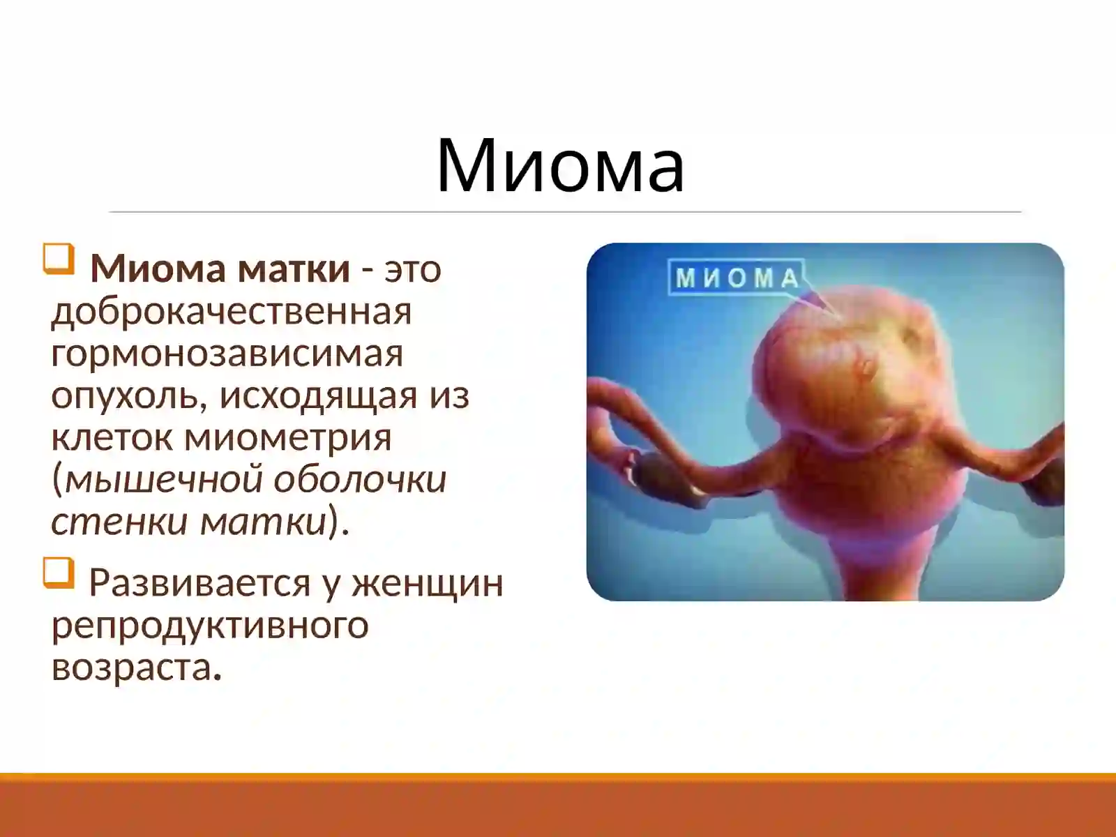 Миома матки 2