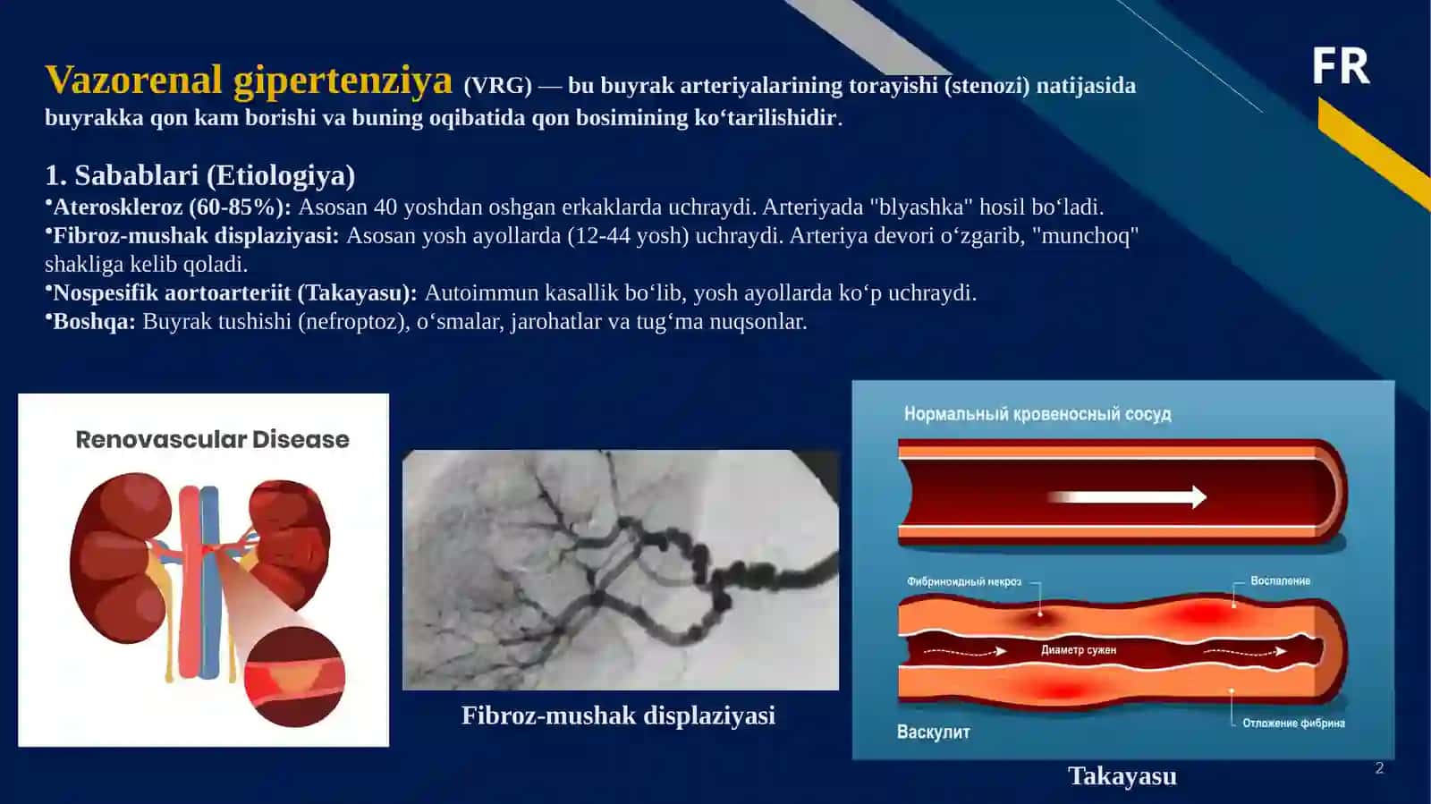 Simptomatik arterial gipertenziya, O‘tkir arterial tutilishi 2