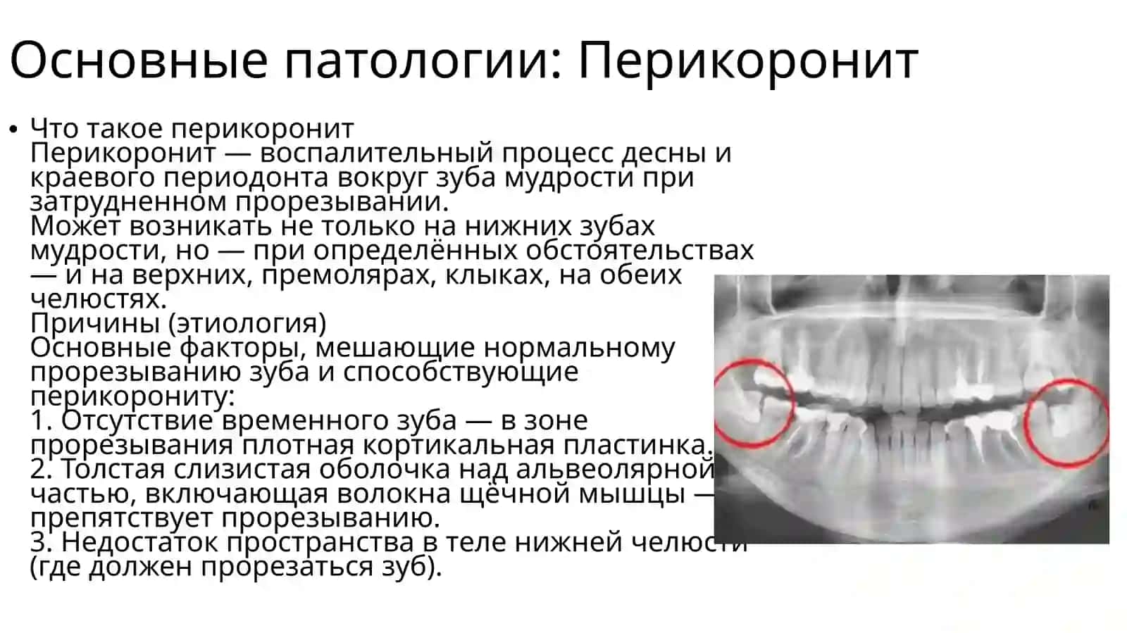 Болезни прорезывания зубов: перикоронит, ретромолярный периостит 3