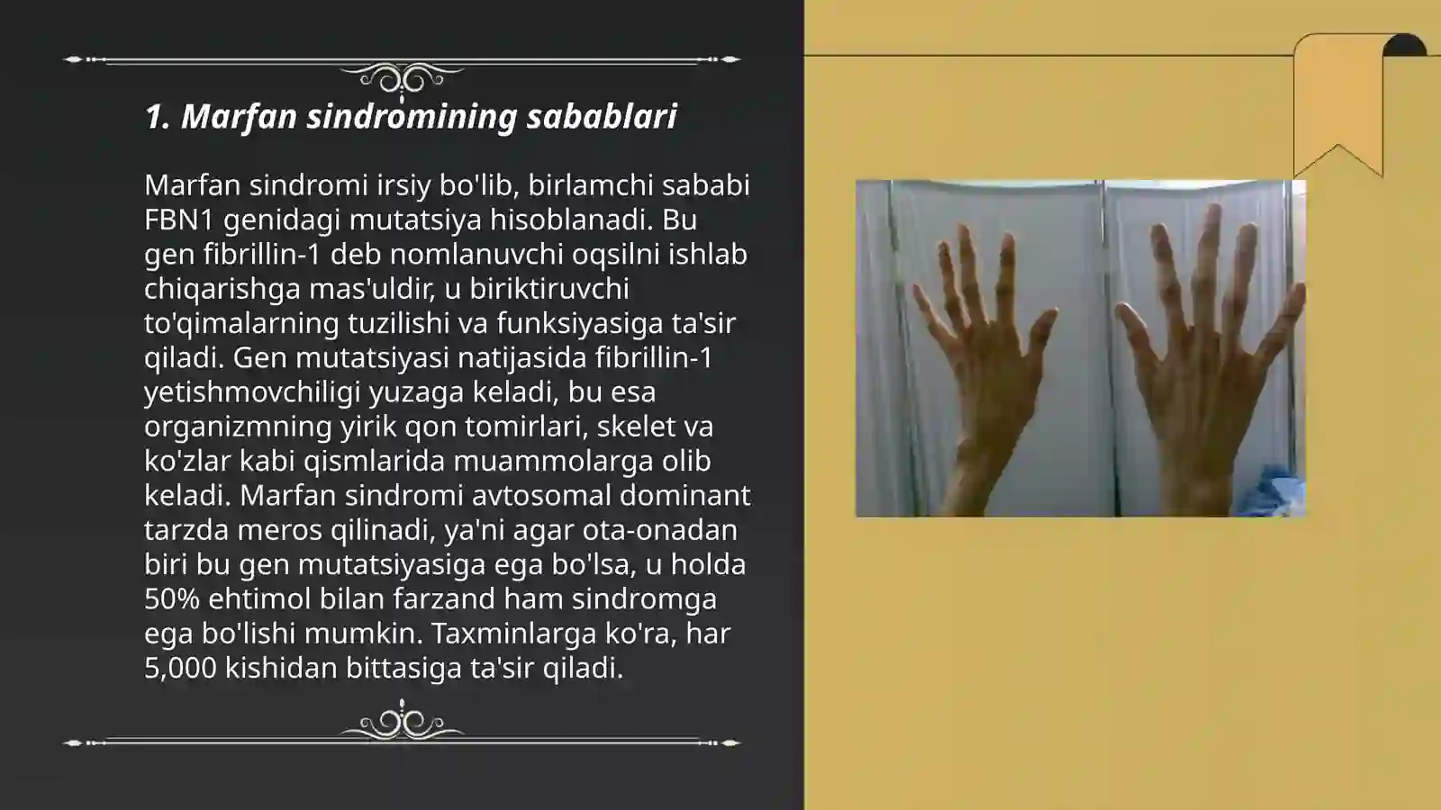 Marfan sindromi 3