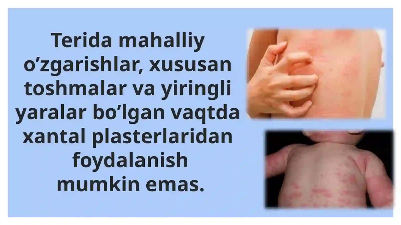 Xantal plasterlari 3