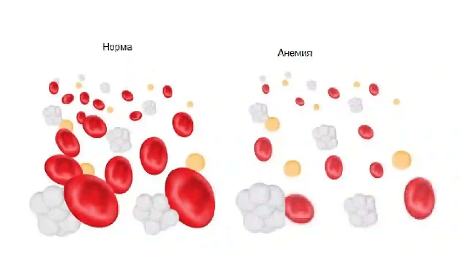 Анемия 3