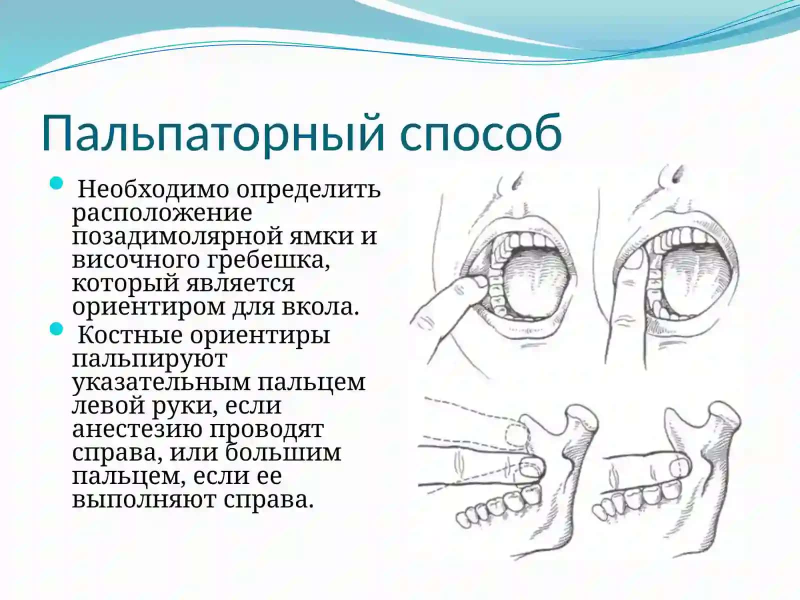 Мандибулярная иторусальная анестезия 3