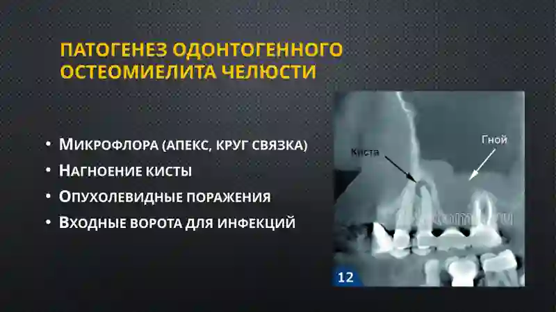 Одонтогенный остеомиелит челюсти 3