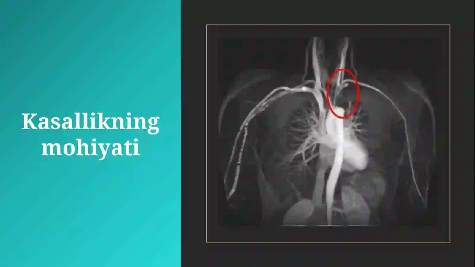 Tizimli vaskulitlar(tugunchali periartrit, nospetsifik aortoartrit, Vegenar granulematoz) 3