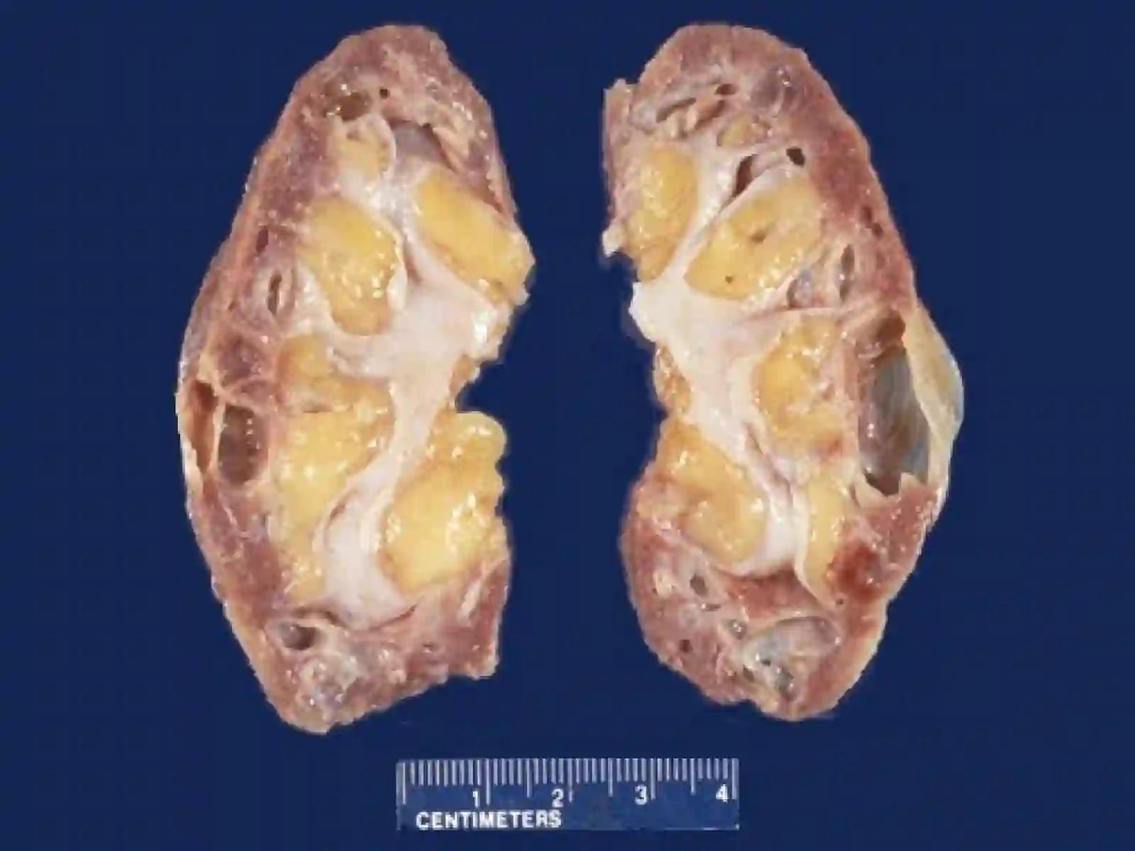 SURUNKALI BUYRAK YETISHMOVCHILIGI ETIOLOGIYASI, PATOGENEZI, TASNIFI KLINIK SINDROMLARI DIAGNOSTIKASI VA DAVOLASHDA QO’LLANILADIGAN DORI VOSITALARINING FARMOKODINAMIKASI 3