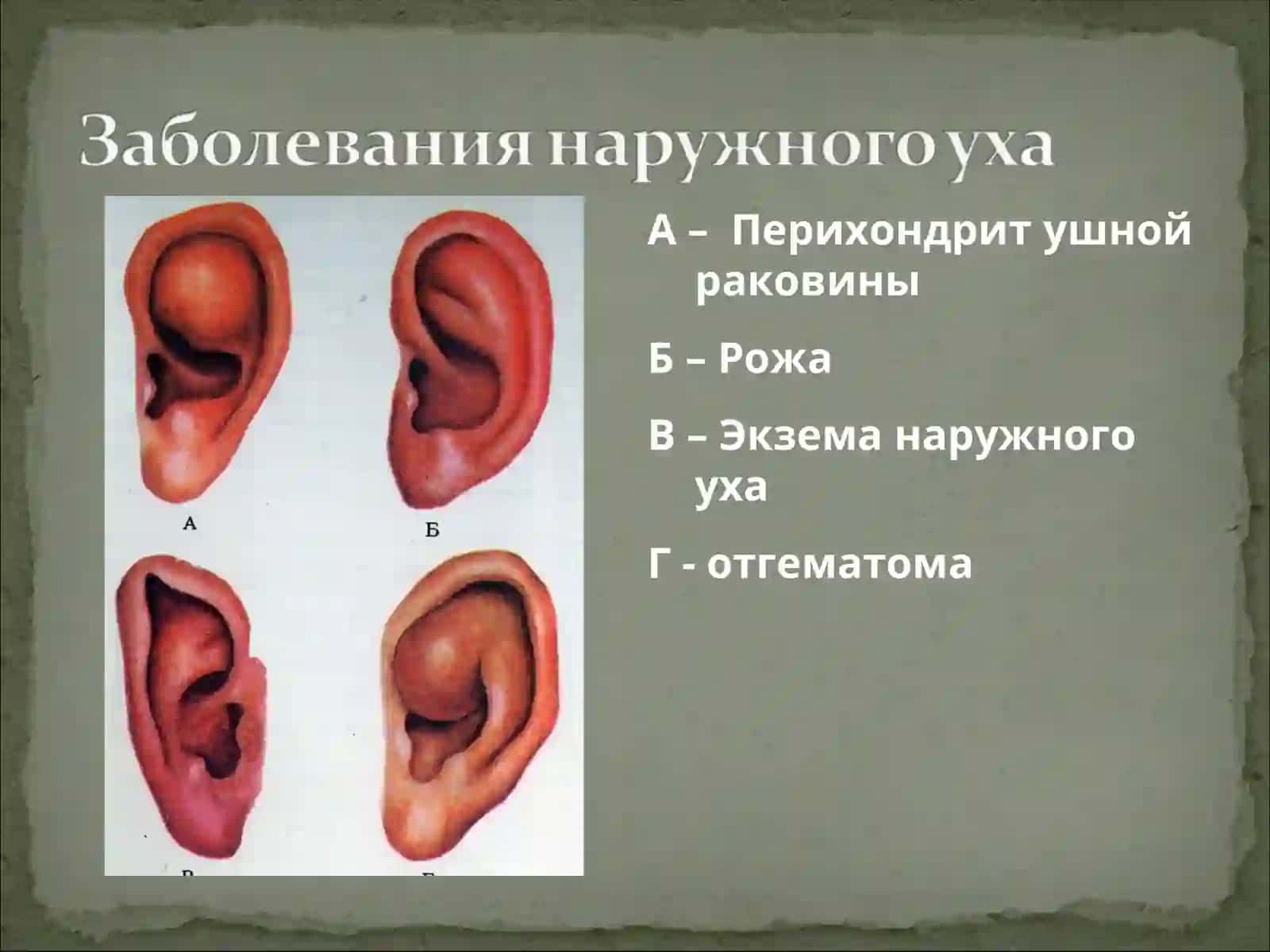 Медицинские аспекты заболеваний уха 3