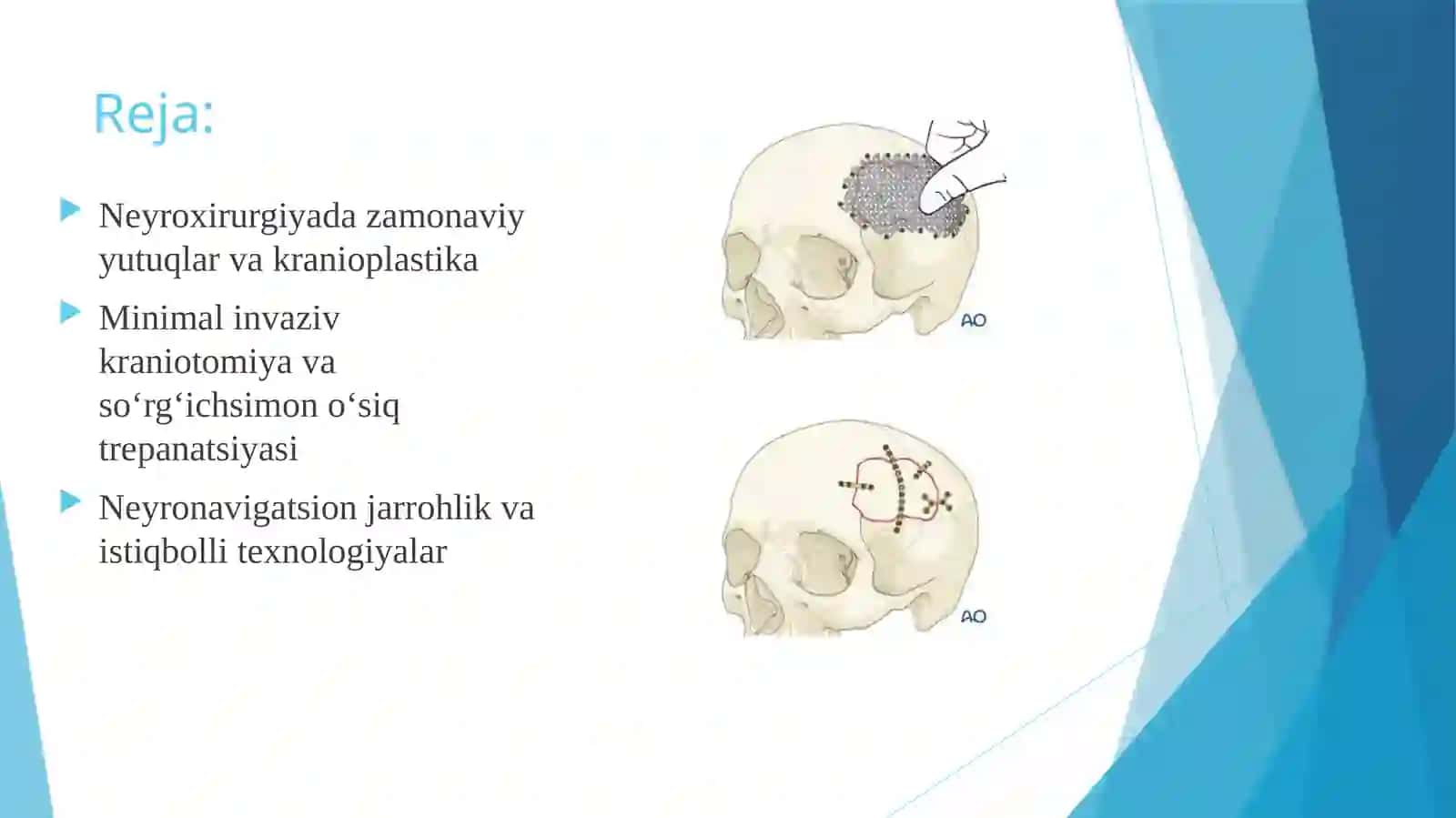 Neyroxirurgiyada qo‘lga kiritilgan yutuqlar va kranioplastika 3