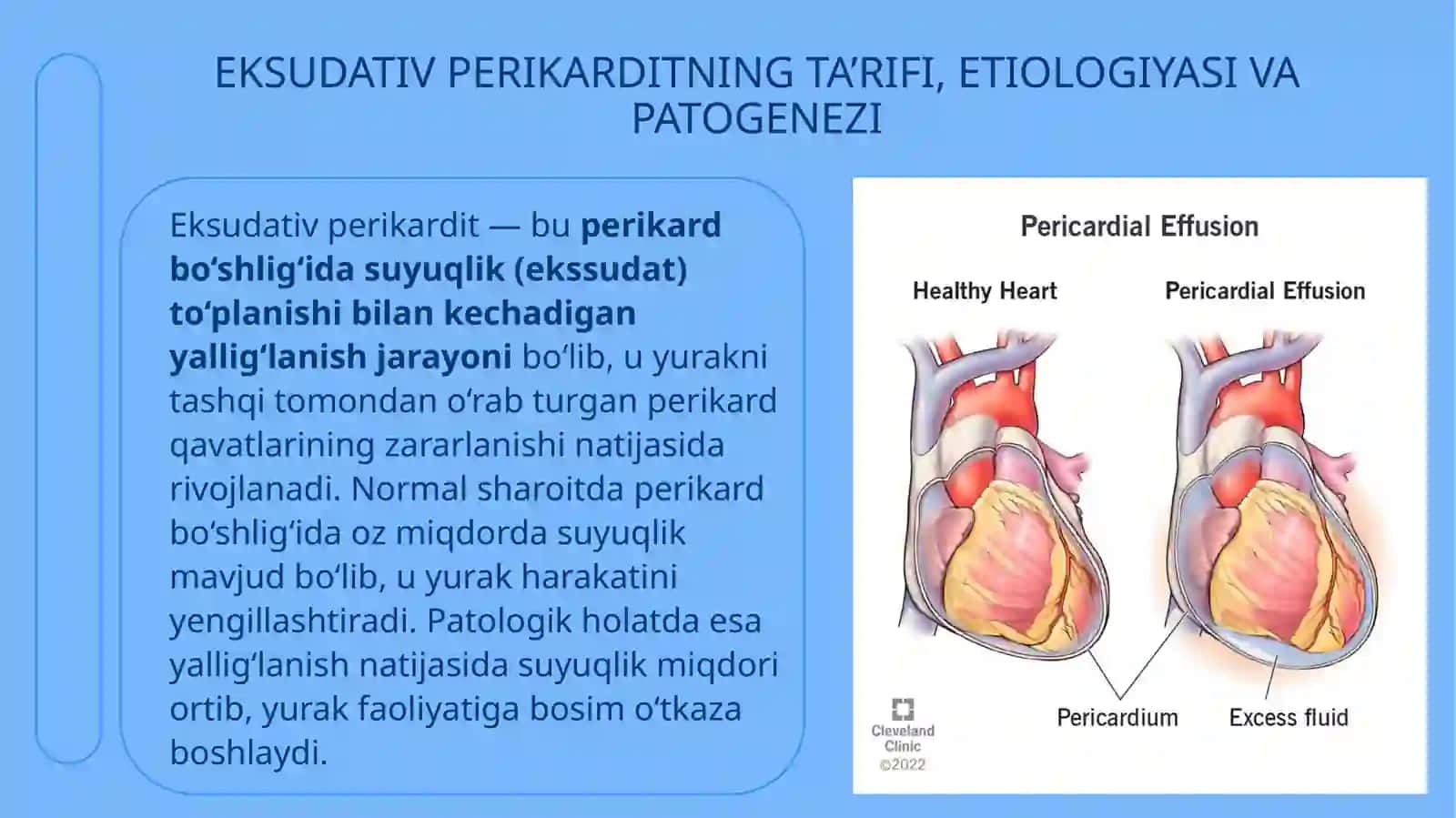 Eksudativperikardit: klinikasi, diagnostikasi, davolash 3