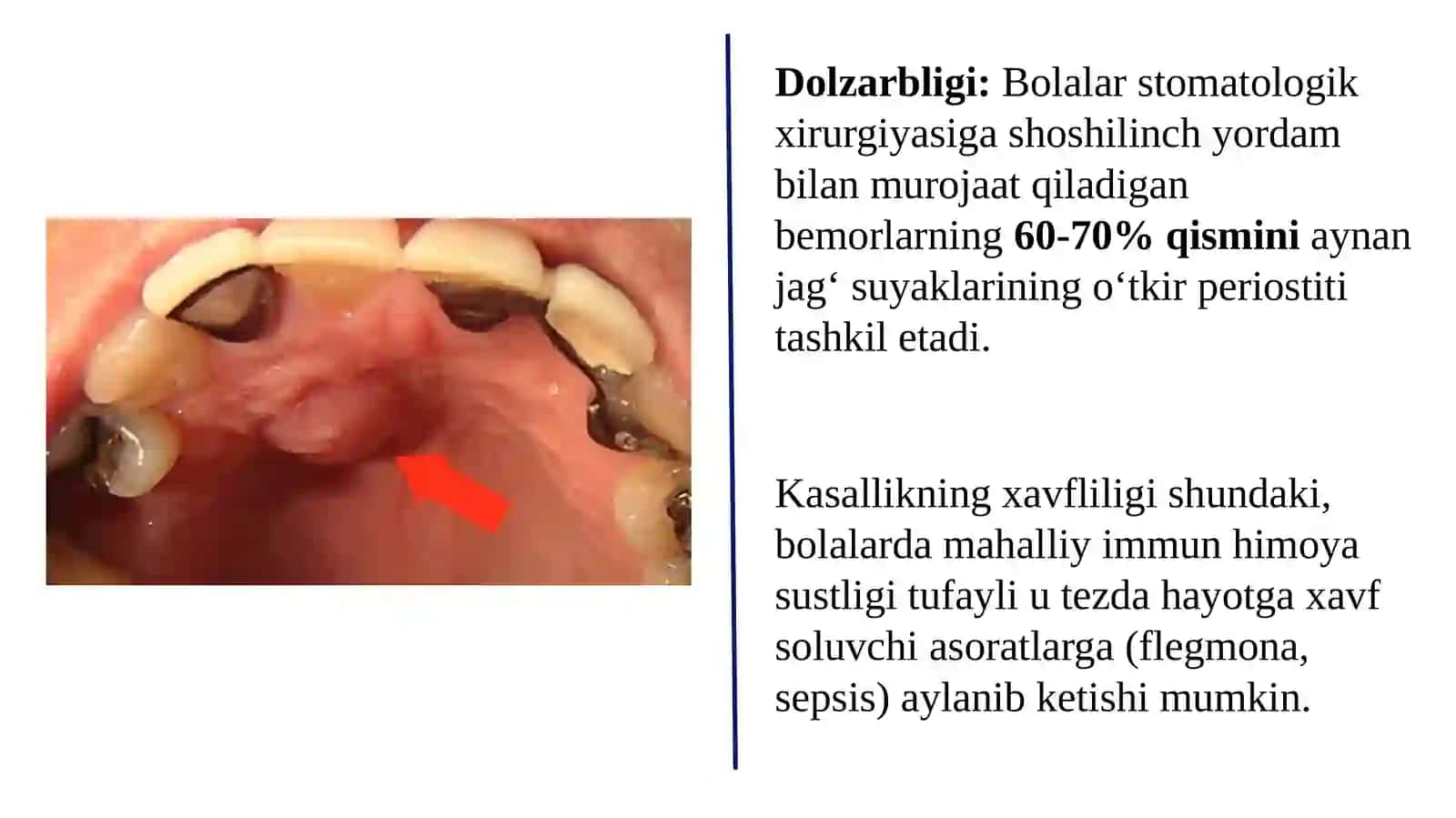 BOLALARDA JAG‘ SUYAGINING O‘TKIR VA SURUNKALI PERIOSTITI 3