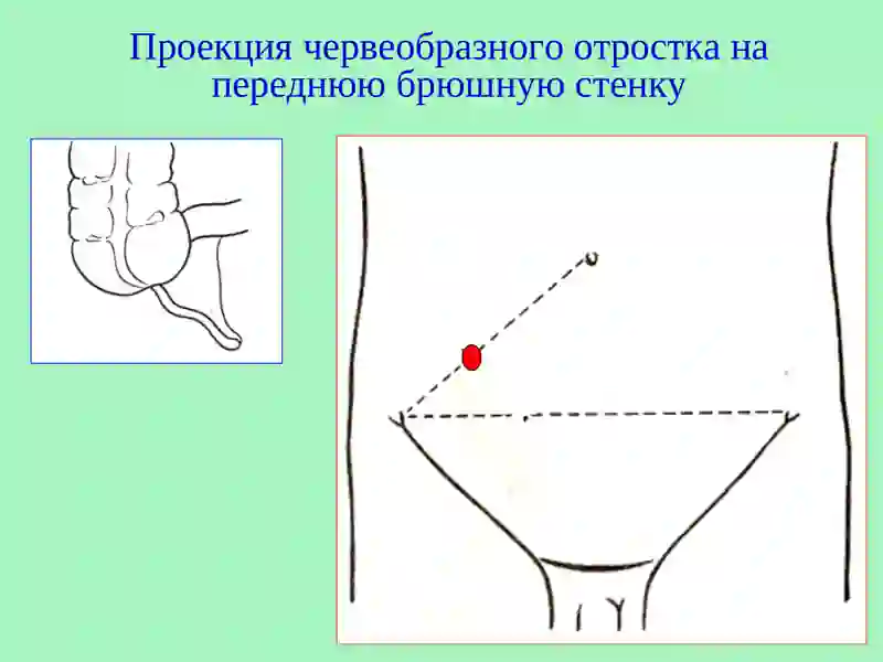 Острый аппендицит 3