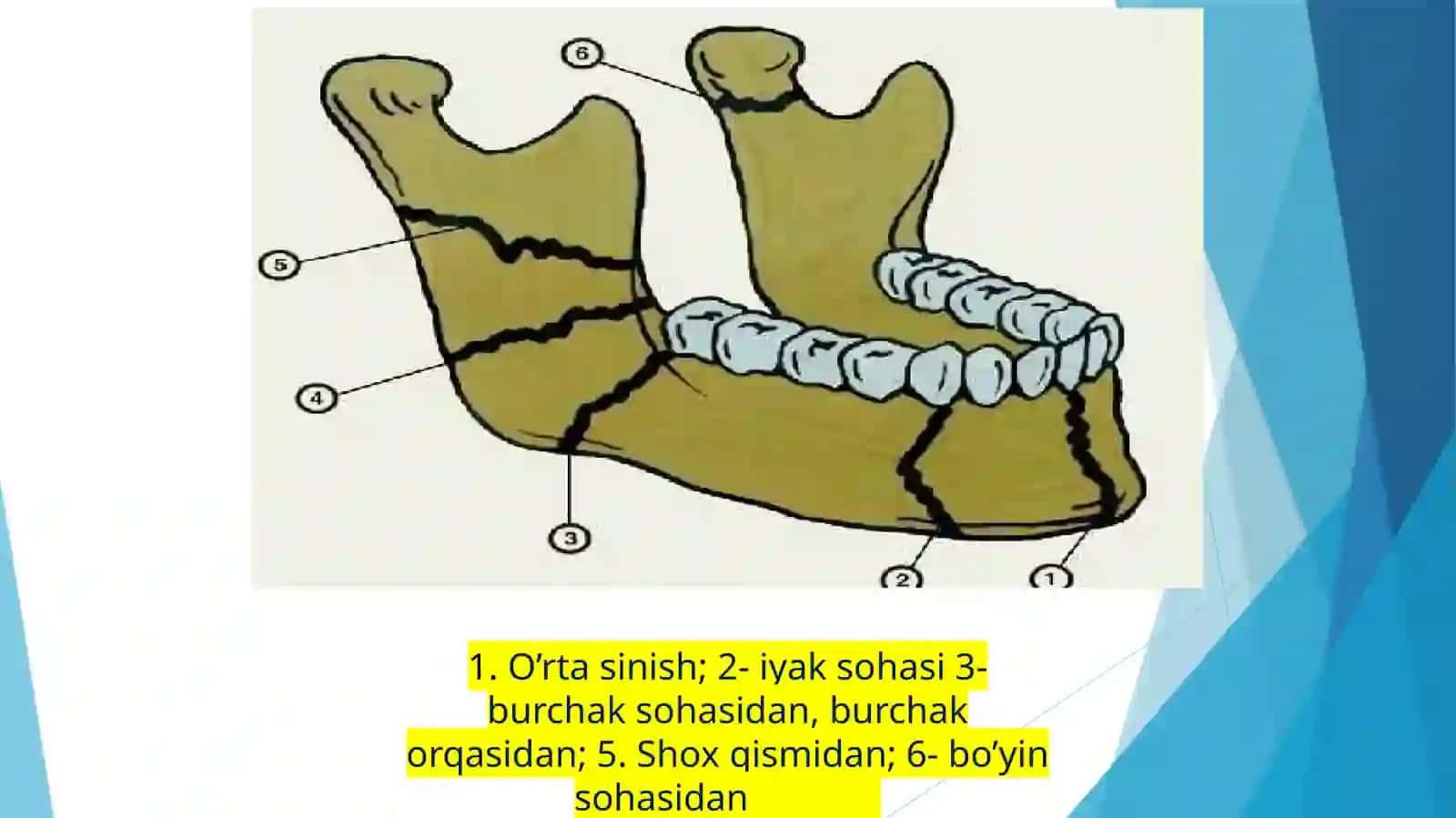 Bolalarda pastki jag’ning 5-sut hamda 6-doimiy tishlar sohasida sinishi. 3