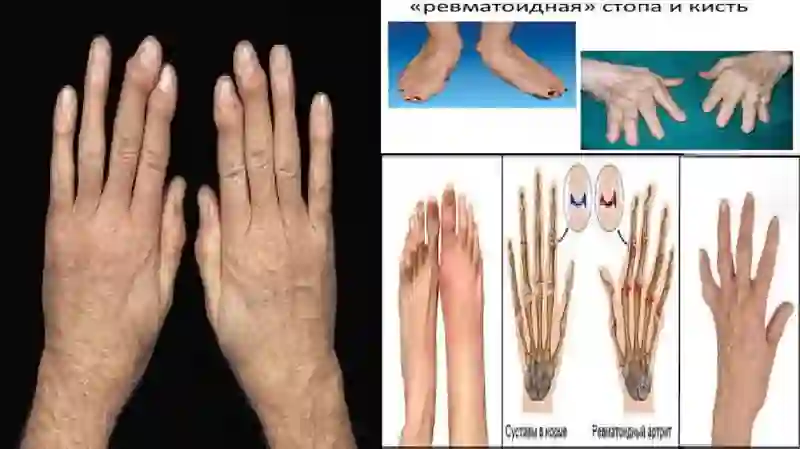 Osteoartrozning davolash jarayoni 3