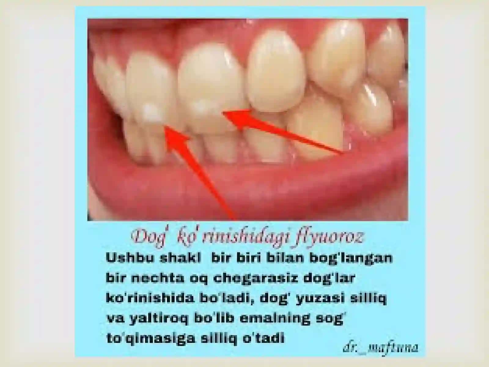 Tish qattiq to’qimalarining nokariyes kasalliklari  profilaktikasi usullari. 3