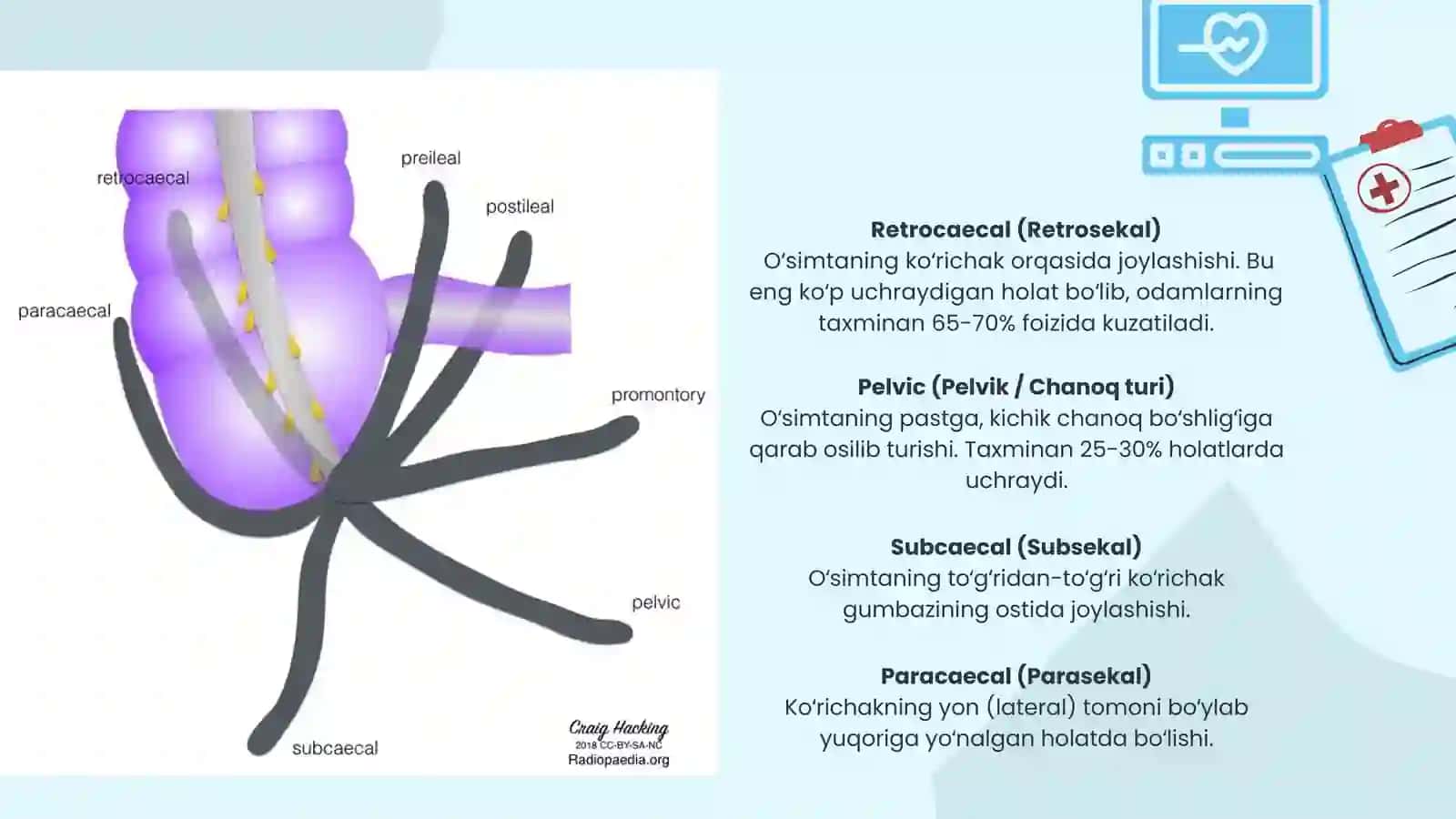 Appenditsit nur tashxis usullari. 3