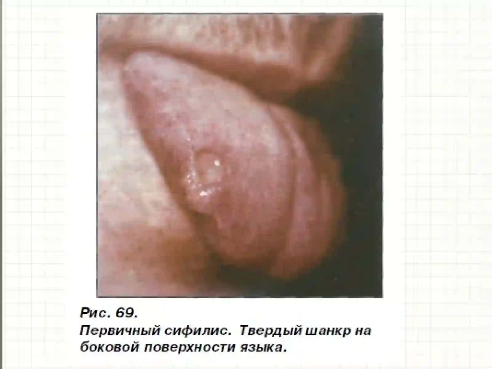Tanosil kasalliklarini OBShQda namoyon bo’lishi. Zahm. Gonoreya. 3
