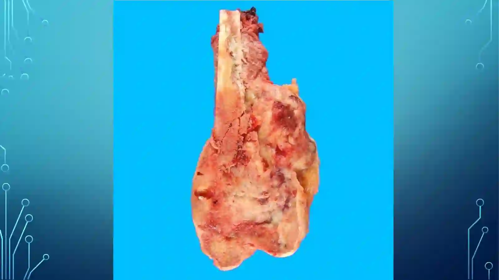 Osteosarkoma 3