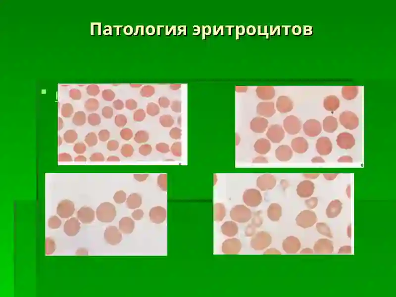 АНЕМИЯ 3