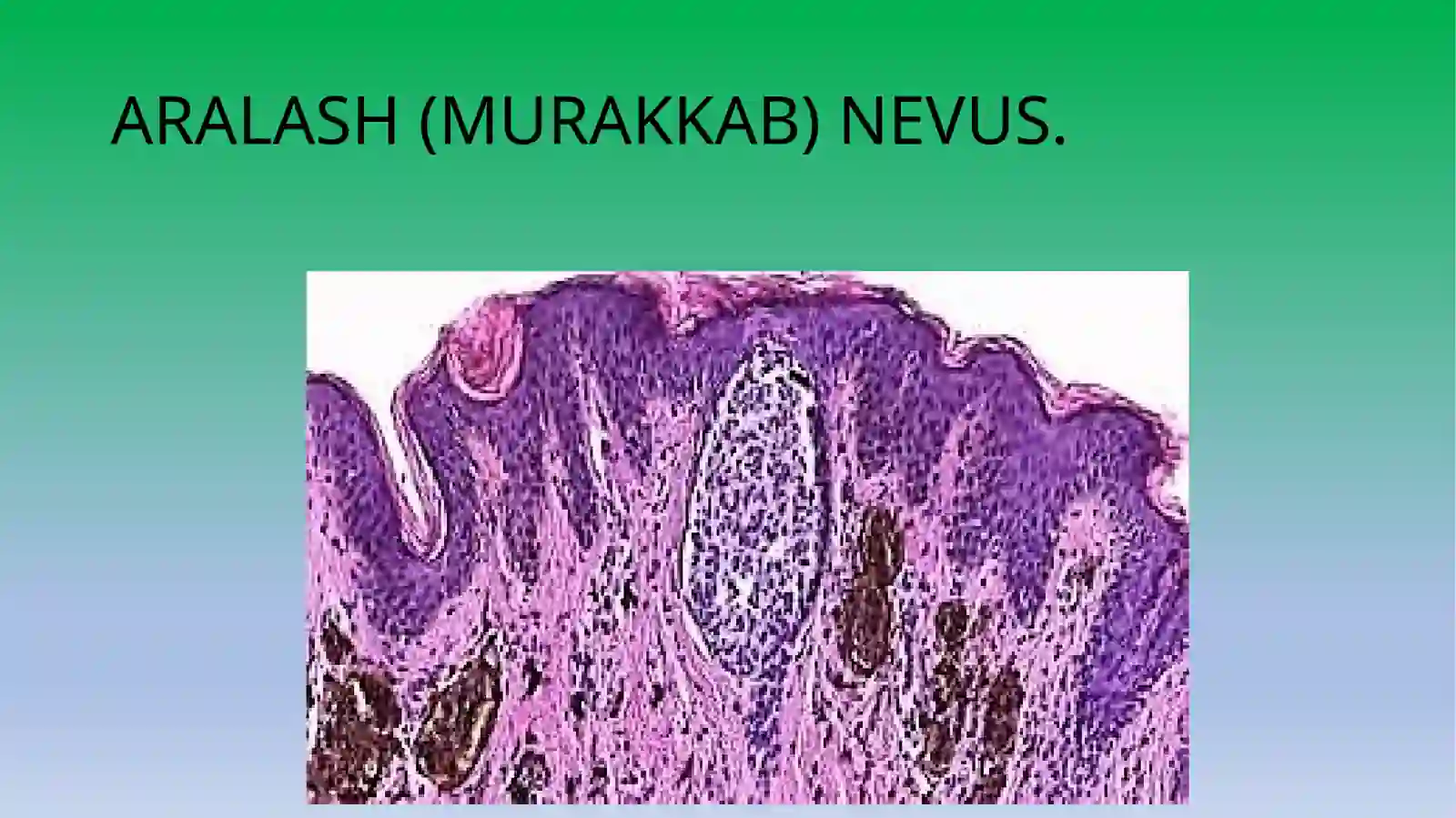Chegaradagi nevus 3