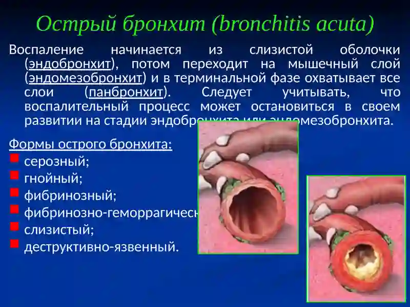 Острый бронхит (bronchitis acuta) 3