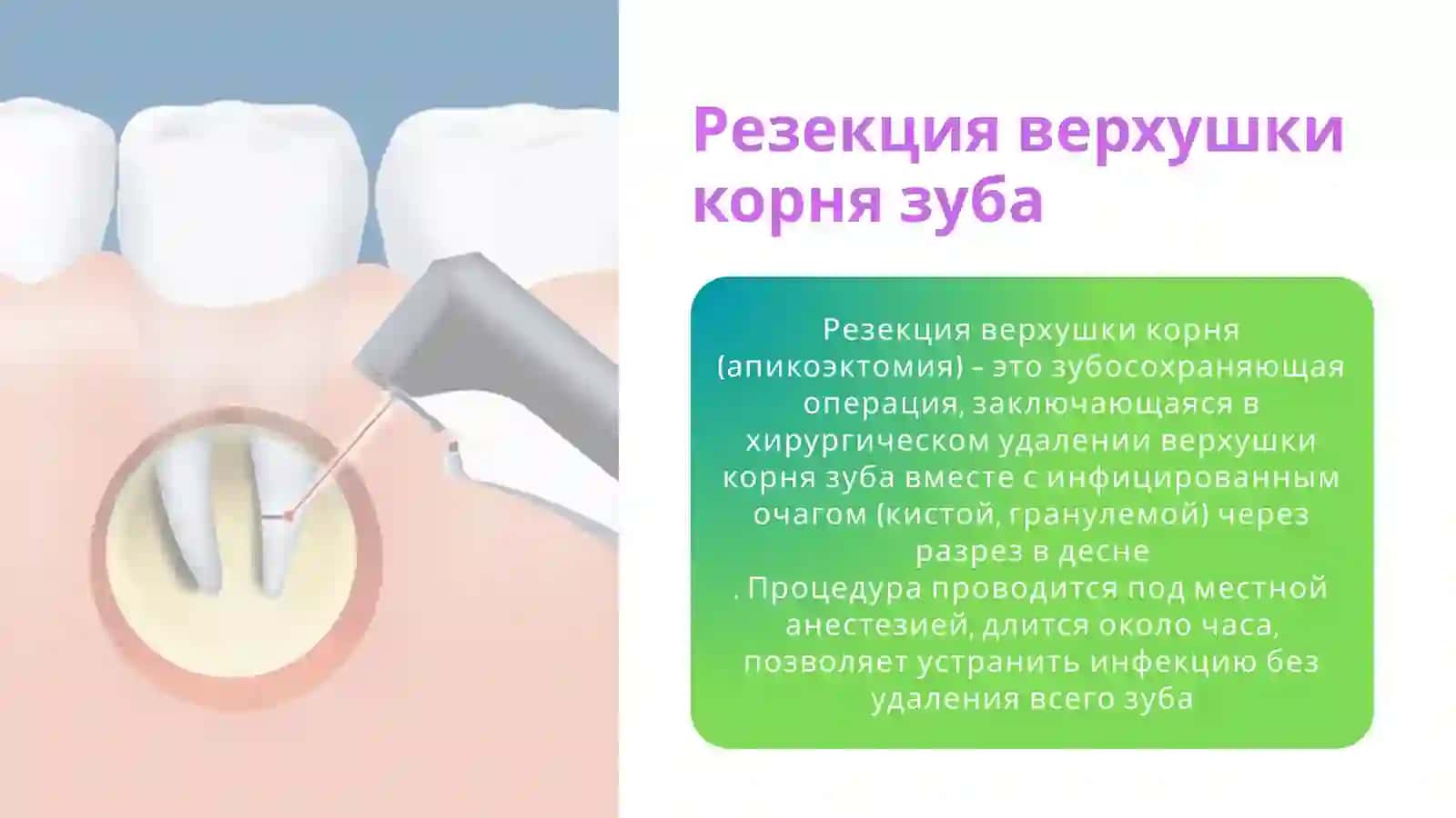 ХИРУРГИЧЕСКОЕ ЛЕЧЕНИЕ ПЕРИОДОНТИТОВ 3