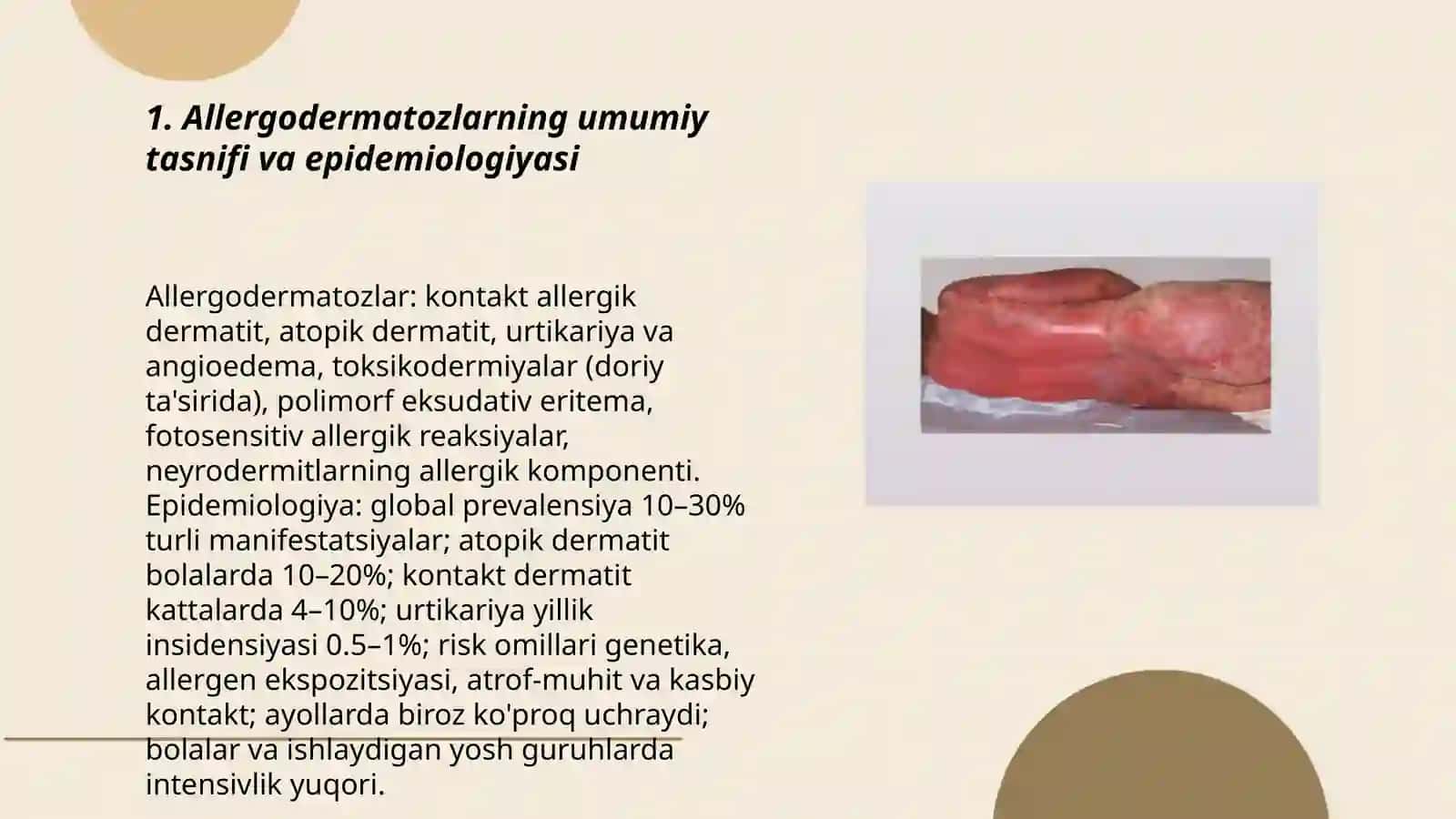 Allergodermatozlar. Dermatitlar. Toksikodermiyalar. Oddiy va allergik kontaktli dermatitlar. Toksikodermiyalar, sulfanilamid eritemasi 3