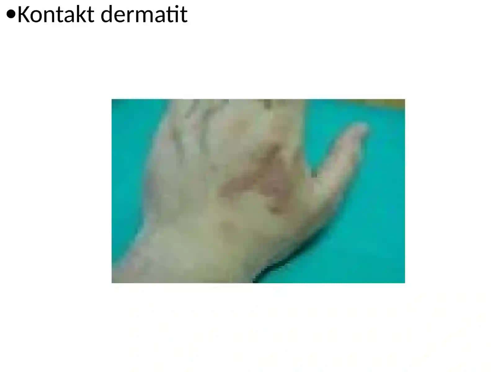 Dermatitlar 3