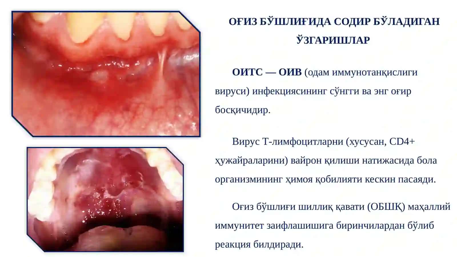 Орттирилган иммунитет танқислиги синдроми (ОИТС) билан касалланган болалар оғиз бўшлиғида содир бўладиган ўзгаришлар 3