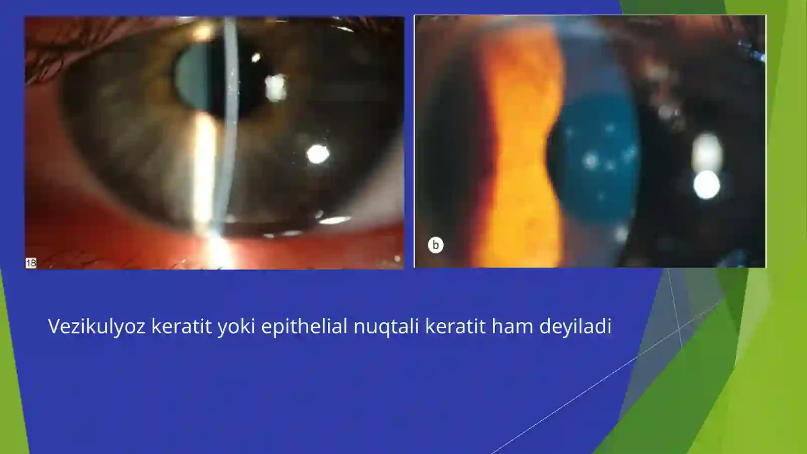 Gerpetik keratitlar 3
