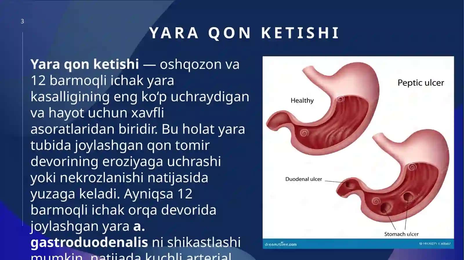 Oshqozon va 12 bar-moqli ichak yaralari mamlakati 3
