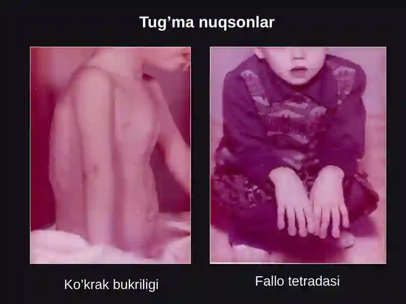 Tug'ma yurak nuxsonlari ppt 3