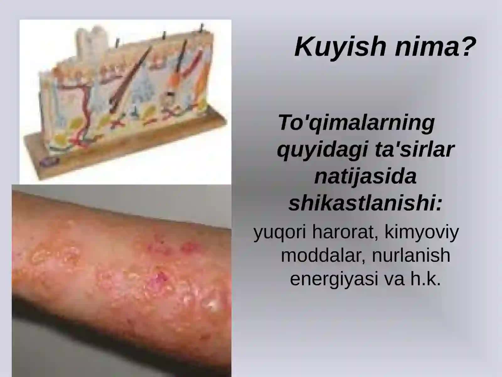 Kuyish jarohatlari va ularning tasnifi (PPTX) 3