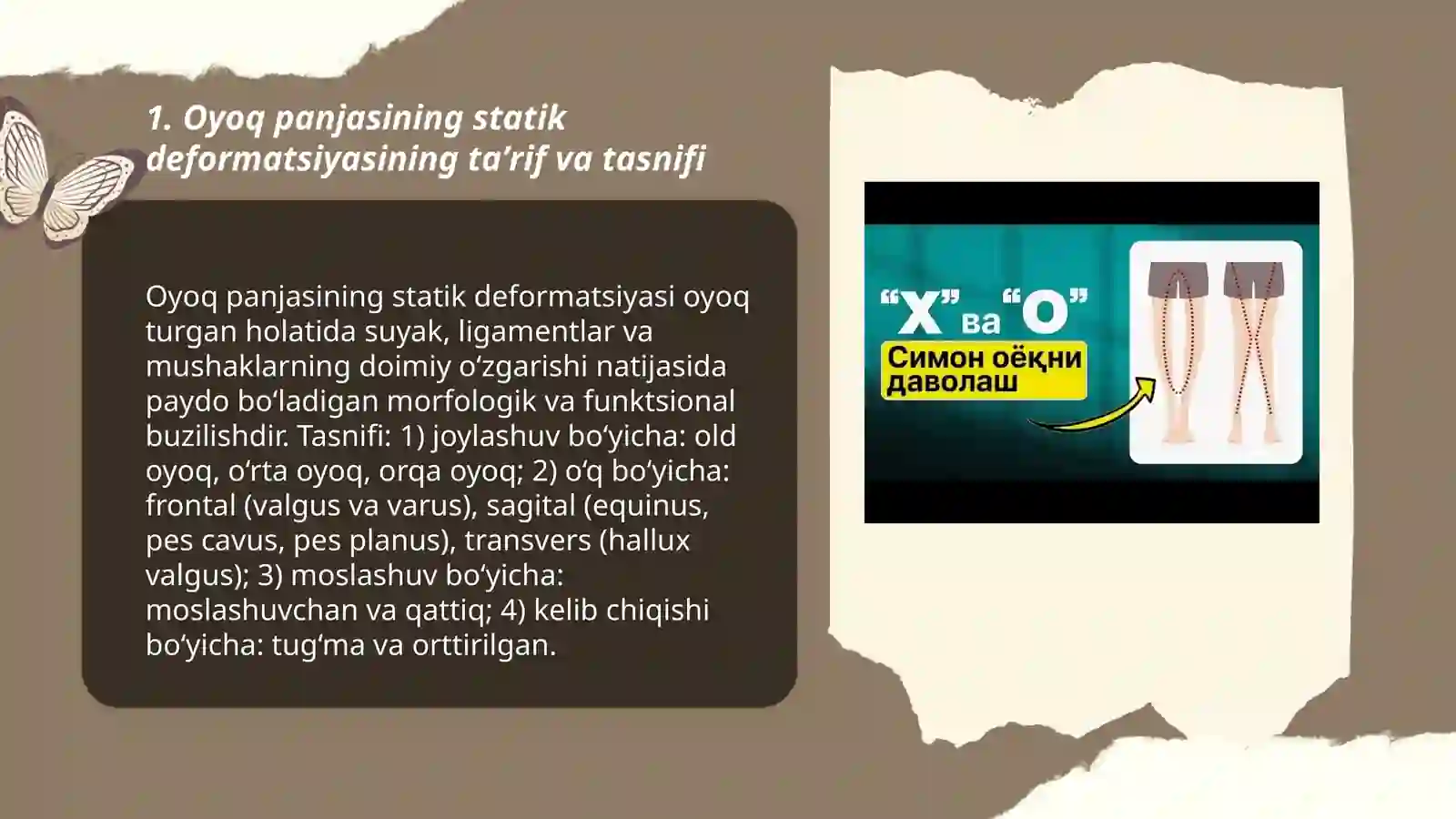 Oyoq panjasining statik deformatsiyasi 3