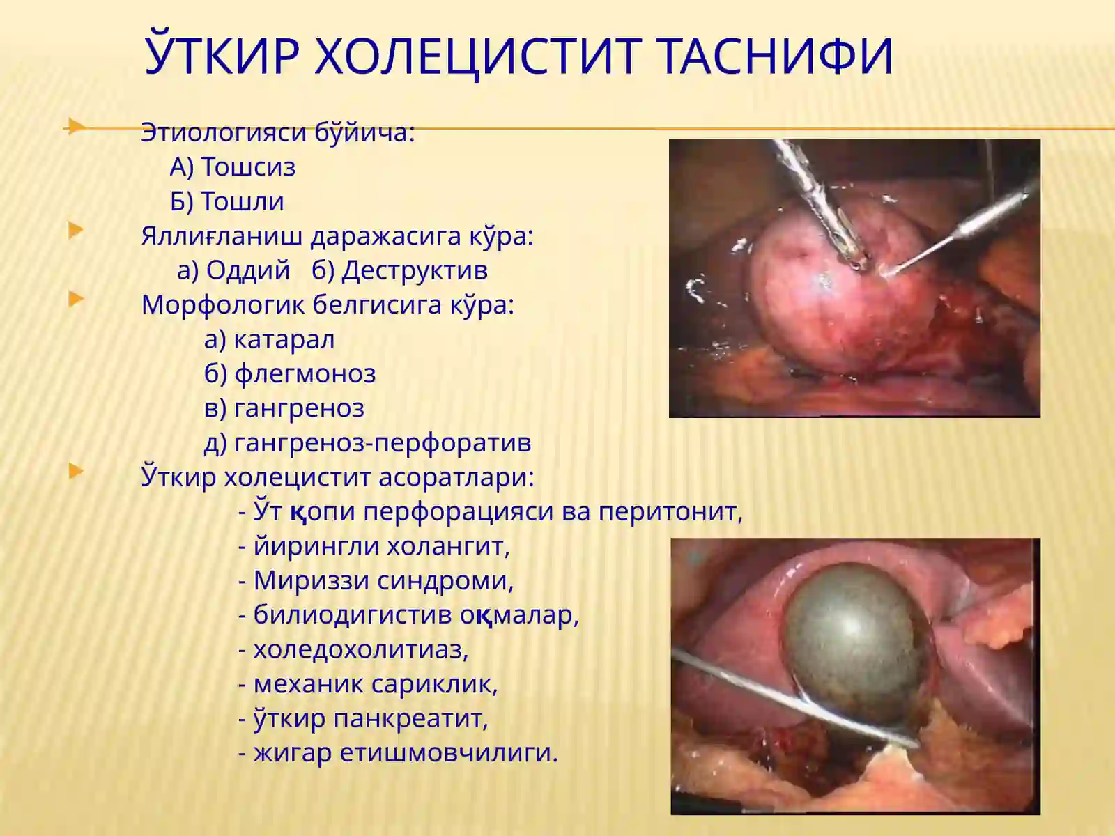 Ўткир тошли холецистит 3