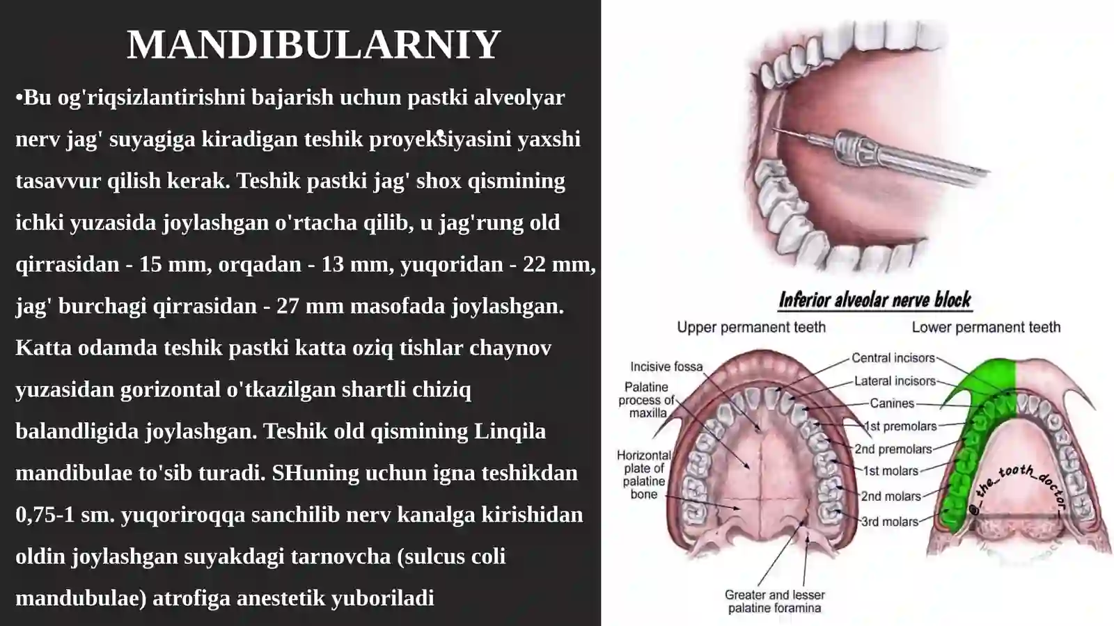 Stomatologiyada patstki jagʻda oʻtkaziladigan oʻrinsizlantirish haqida 3