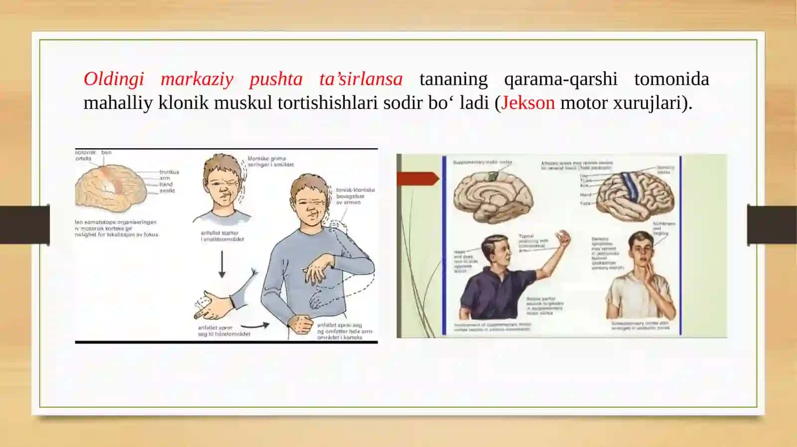 Harakat yo‘lining zararlanishi ni topik diagnostikasi 3
