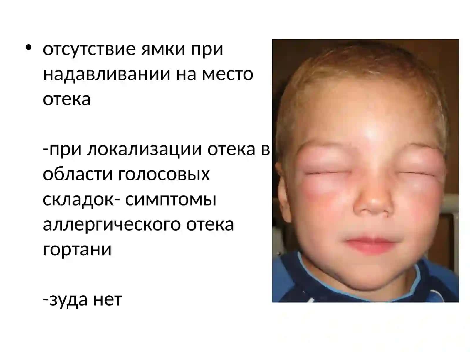 ОтекКвинке. Крапивница.Неотложная помощь 3
