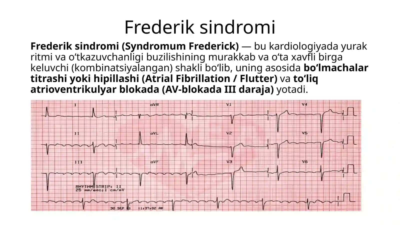 Yurak ritm va o‘tkazuvchanligi buzilishining murakkab turlari: Frederik sindrom, qorinchalarning vaqtidan oldin qisqarishi 3