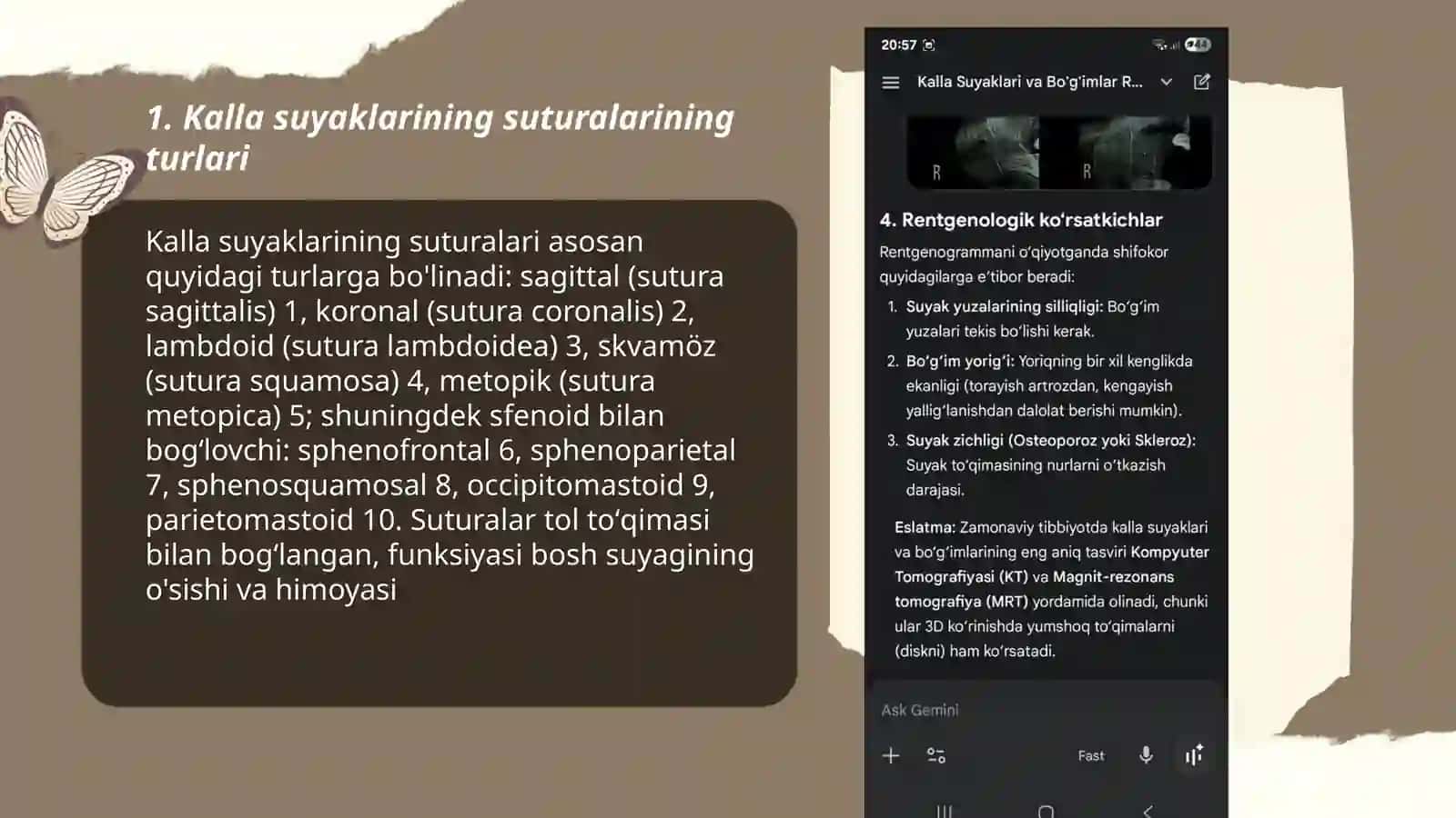 Kalla suyaklarining birlashuvi 3