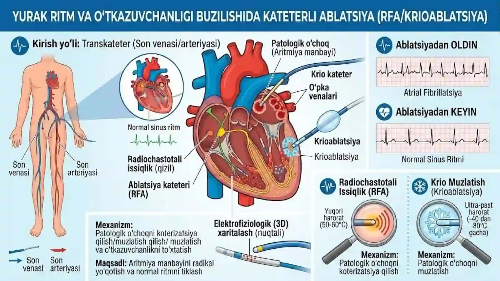 Yurakritm vaoʻtkazuvchanligi buzilishlari 3