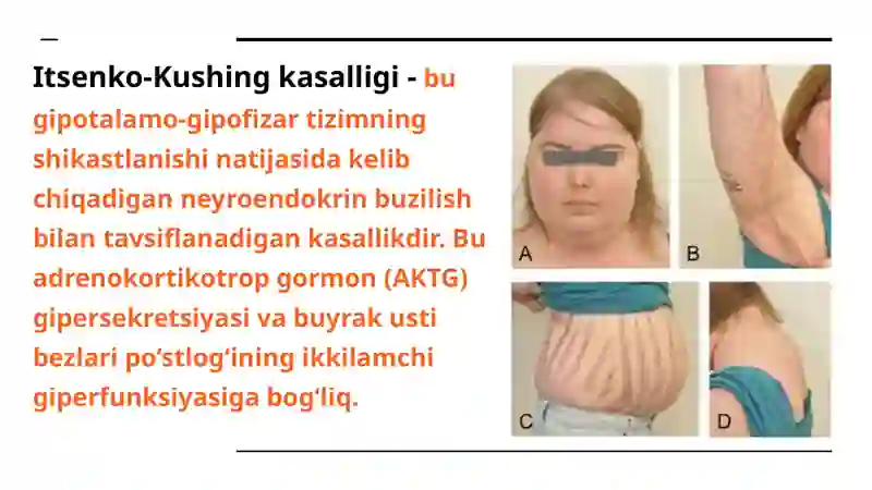 Itsenko-Kushing kasalligi va Sindromi 3