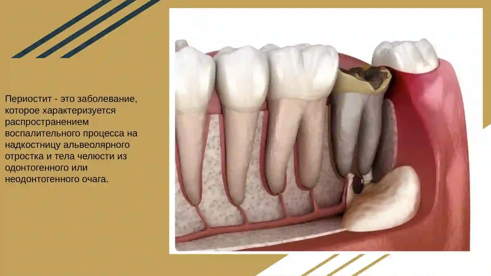 Периостит 3
