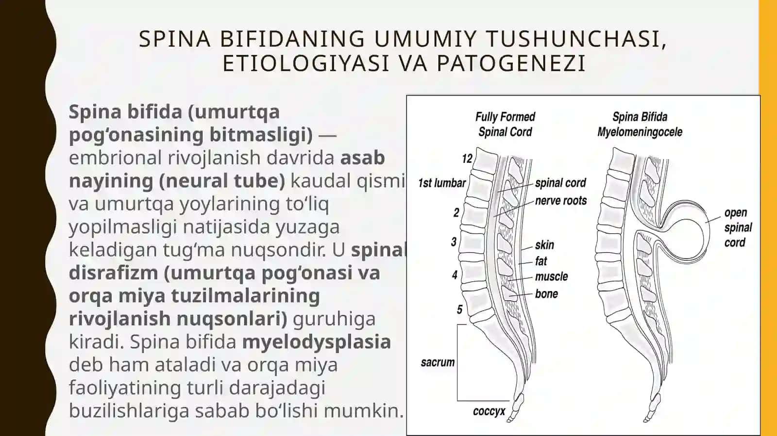 Spina bifida 3