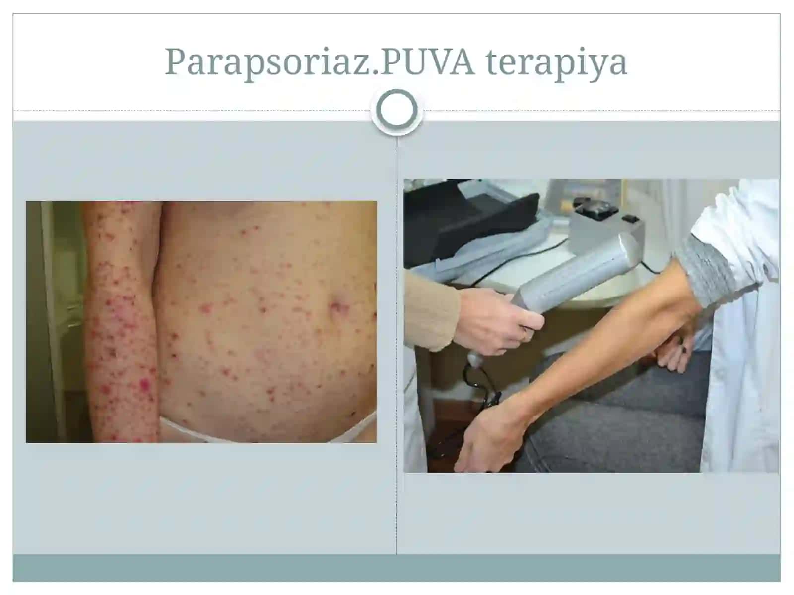 |Professional dermatozlar. Parapsoriaz. Psoriaz va
boshqa dermatozlarda davolashda kvant (PUVA,
reze 3