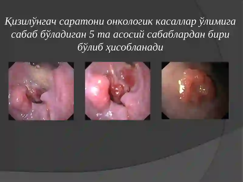 Қизилўнгач саратони 3