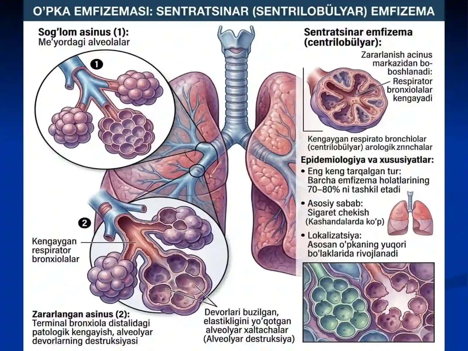 O'PKA EMFIZEMASI PREZENTATSIYA 3