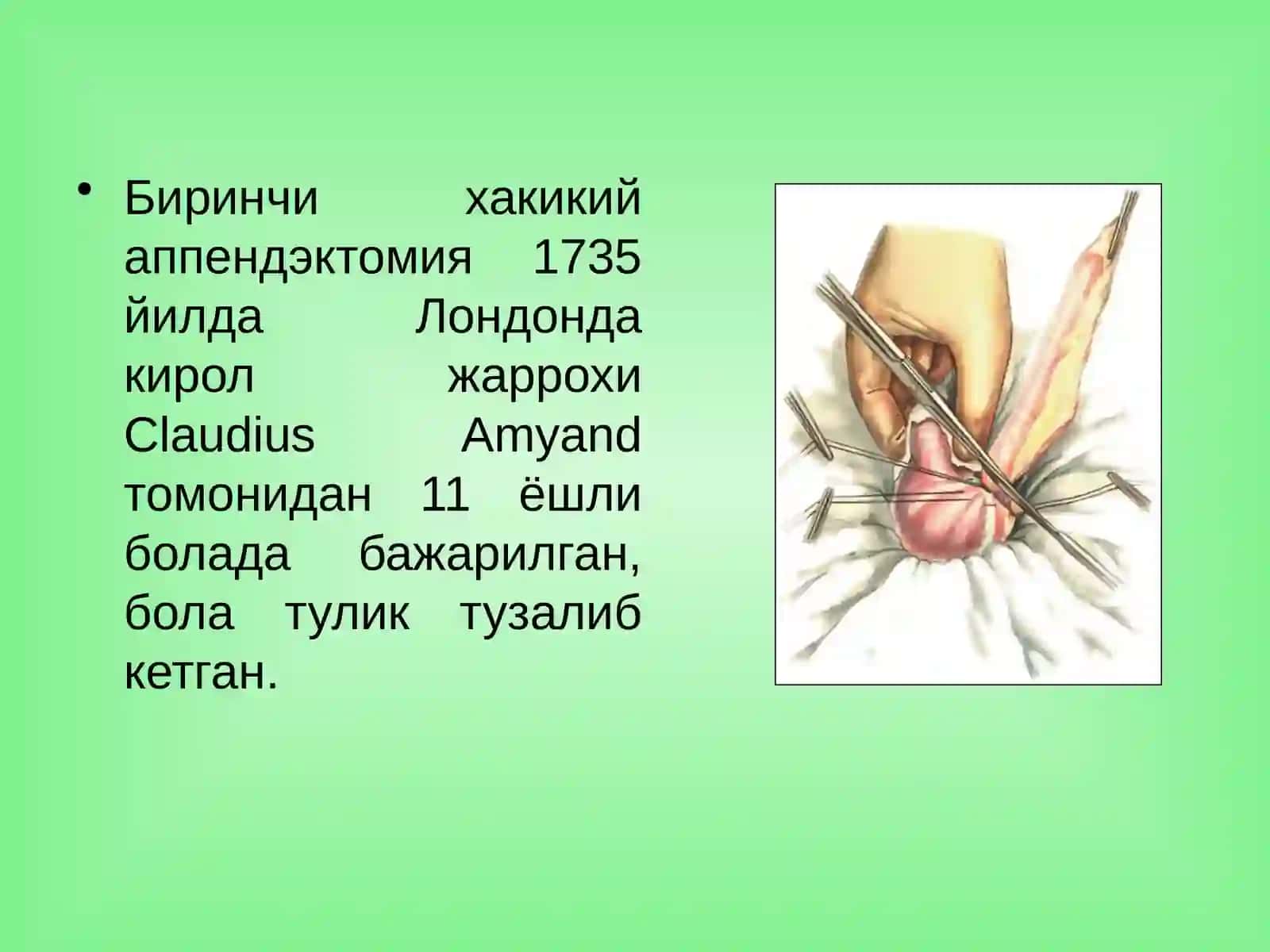 Ўткир аппендицит ва унинг асоратлари 3
