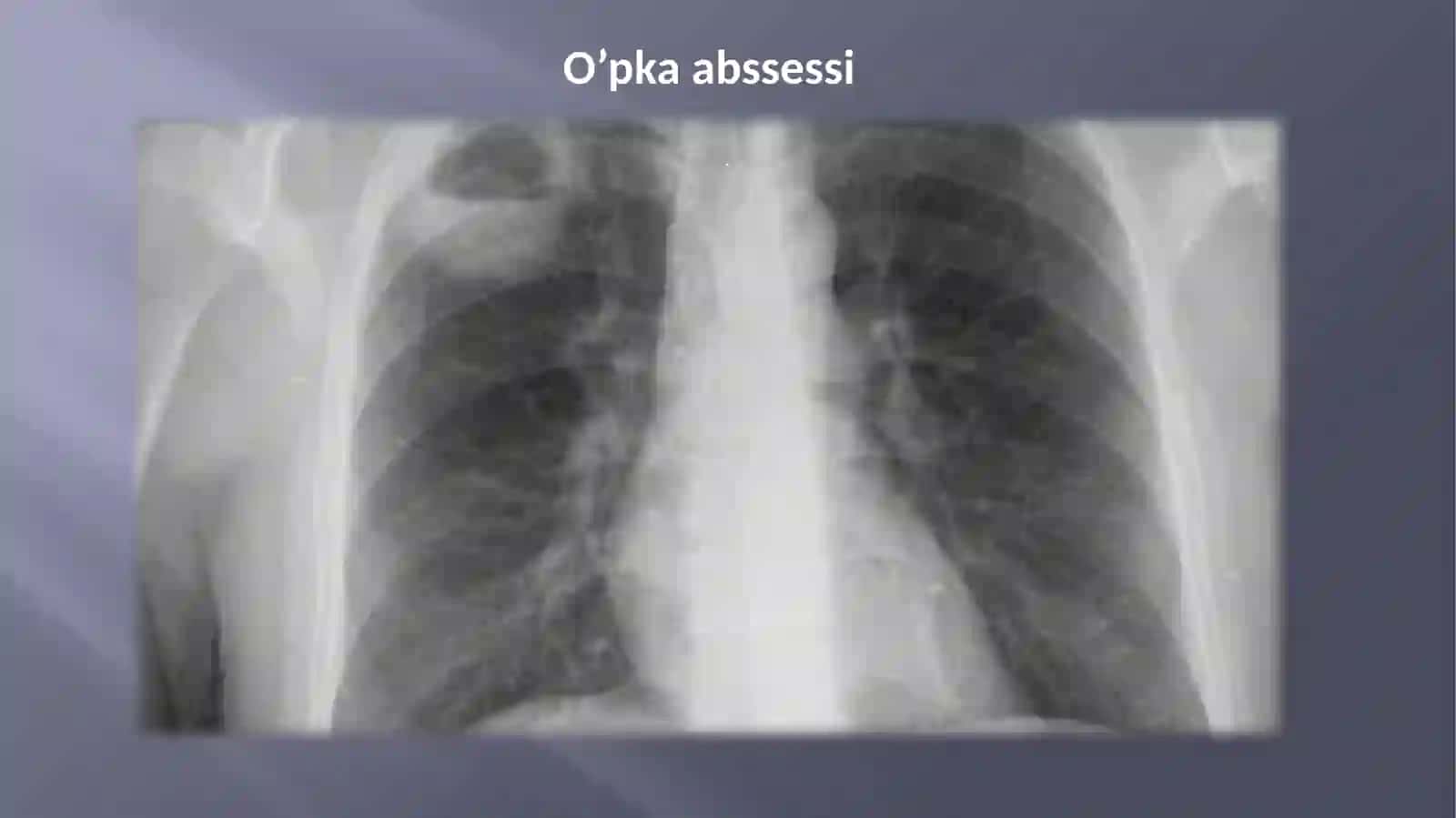 O’pka va plevraning xirurgik kasalliklari abssess va gangrenasi, plevritlar 3