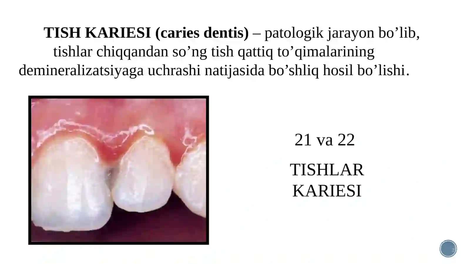 Dog’bosqichidagi karies. Klinikasi 3